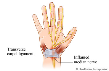 Carpal Tunnel Syndrome Care Instructions